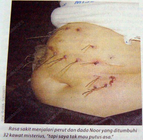 PERUT-KAWAT
