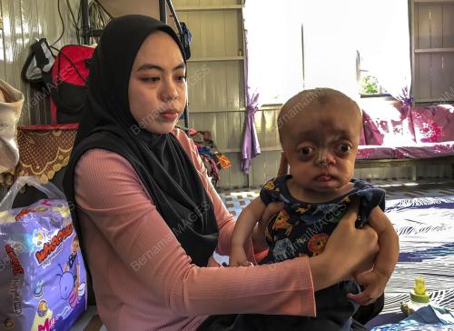 BAYI SEMBILAN BULAN DERITA Ã”PFEIFFER SYNDROMEÃ•
