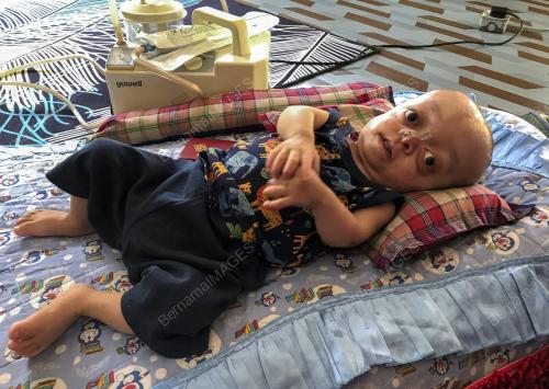 BAYI SEMBILAN BULAN DERITA Ã”PFEIFFER SYNDROMEÃ•