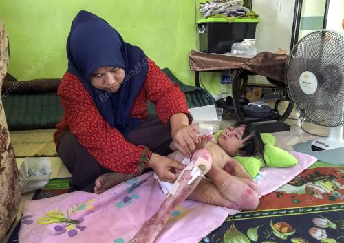 DERITA KULIT RAPUH SEJAK LAHIR