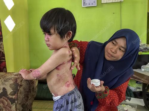 DERITA KULIT RAPUH SEJAK LAHIR