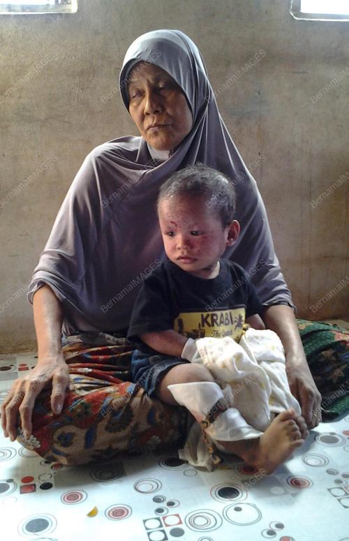 KD01_17022017_SAKIT_KULIT