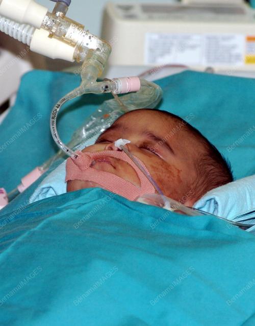 BAYI KEMBAR SIAM