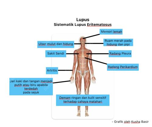 PENYAKIT LUPUS